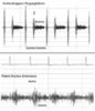Diastolisch und PDA Herzgeräusche Diagram