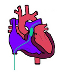 Pulmonalstenoseballon